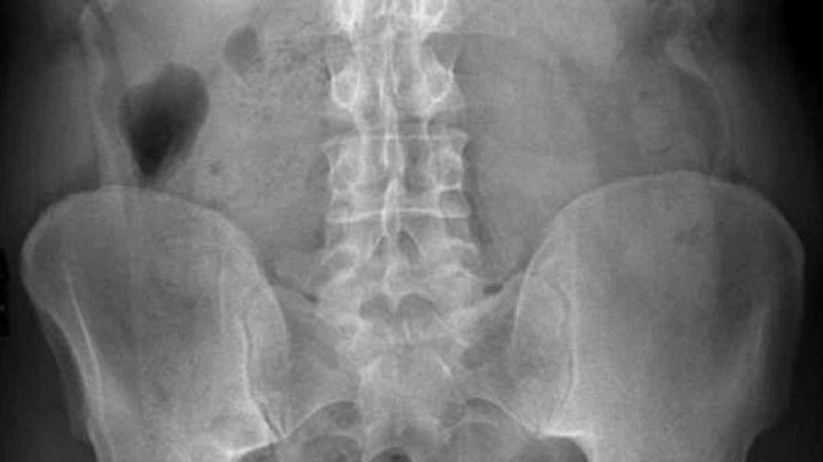 osteoporosis fractura osea investigacion estudio examen genetico