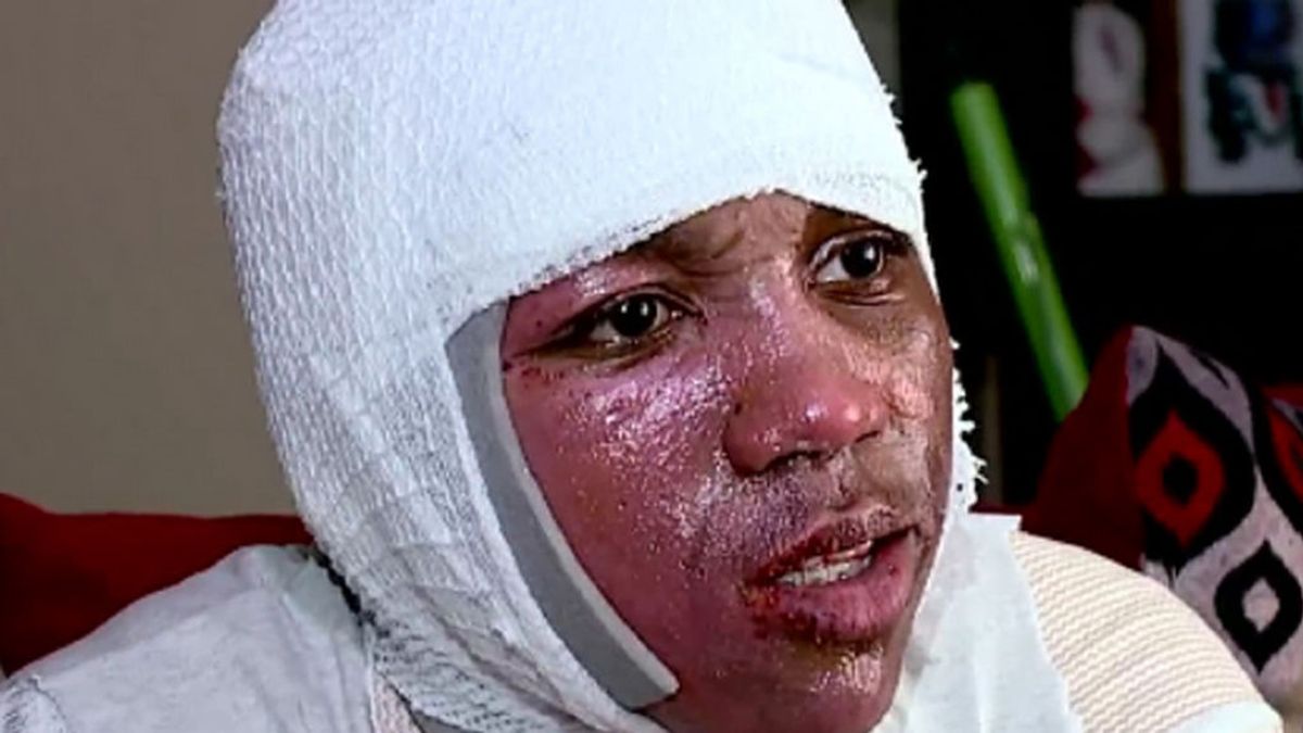 Un desafío viral provoca graves quemaduras en la cara a un adolescente de 15 años