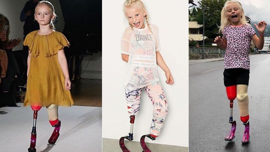 Con 7 años y las piernas amputadas, Daisy-May es todo un ejemplo de superación