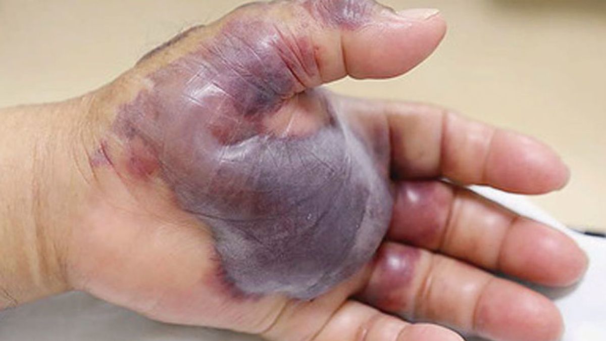 Sushi tóxico:  Le amputan la mano a un hombre de 71 años por una infección contraída tras comer pescado crudo