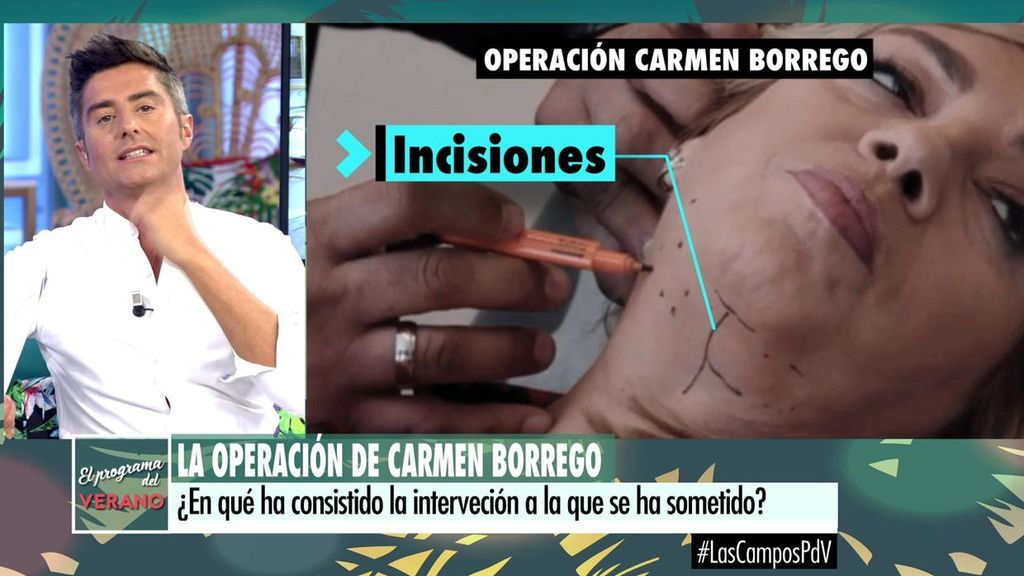 Las operaciones estéticas de Carmen Borrego le cuestan 3.000 euros