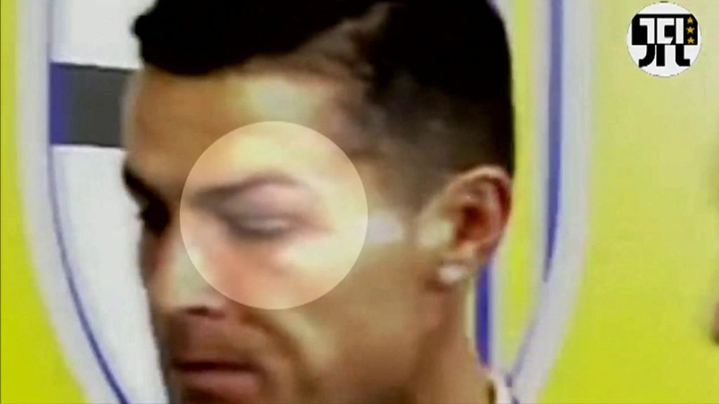 El ojo morado de Cristiano Ronaldo tras un duro golpe con el portero rival