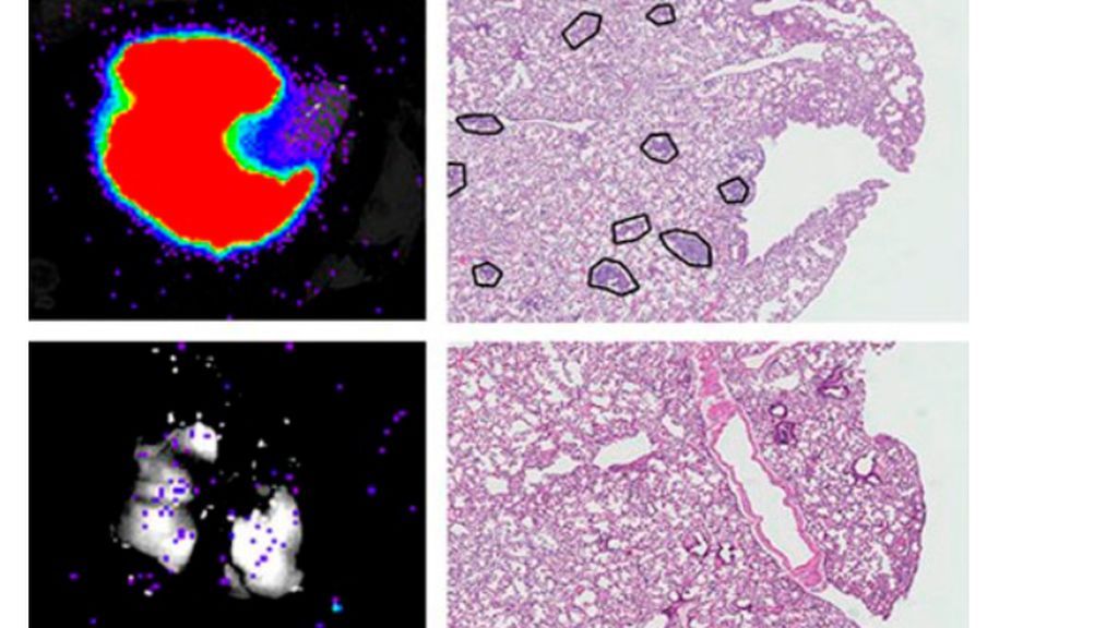 Descubren una encima clave en la proliferación, la invasión y la formación de metástasis de cáncer de mama Descubren una encima clave en la proliferación, la invasión y la formación de metástasis de cáncer de mama