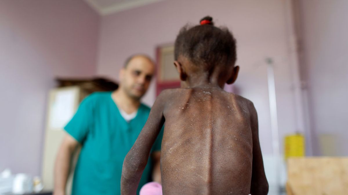 Amal, la trágica imagen de la muerte en Yemen: solo se alimentaba con un poco de leche