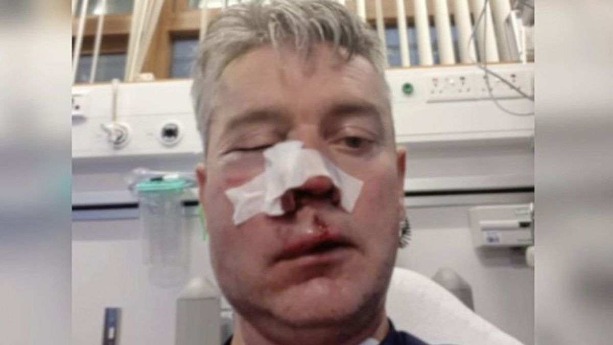 Un árbitro muestra sus heridas por una brutal paliza tras pitar un partido amateur en Irlanda Un árbitro muestra sus heridas por una brutal paliza tras pitar un partido amateur en Irlanda