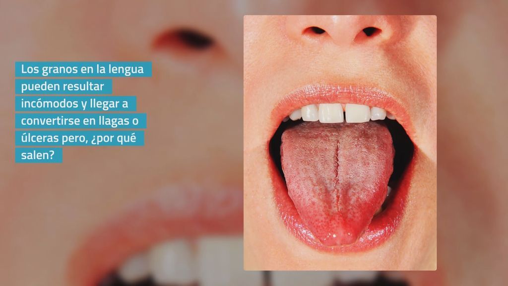 ¿Sabes por qué salen los granos en la lengua? Te mostramos las causas