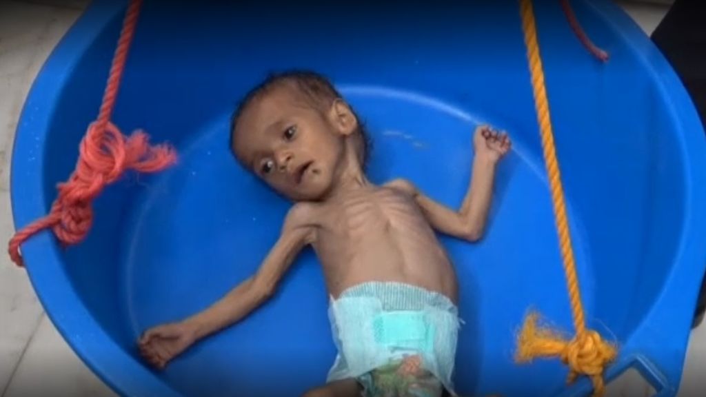 Las desoladoras imágenes que muestran la hambruna que se vive en Yemen