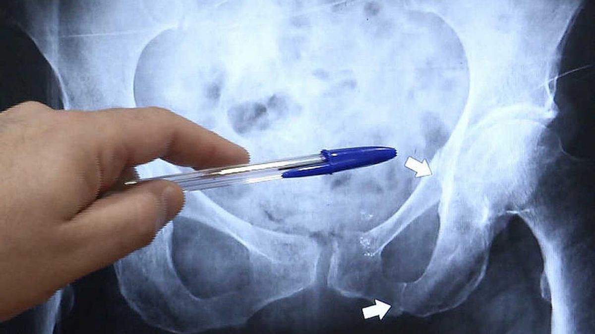 Radiografía de cadera