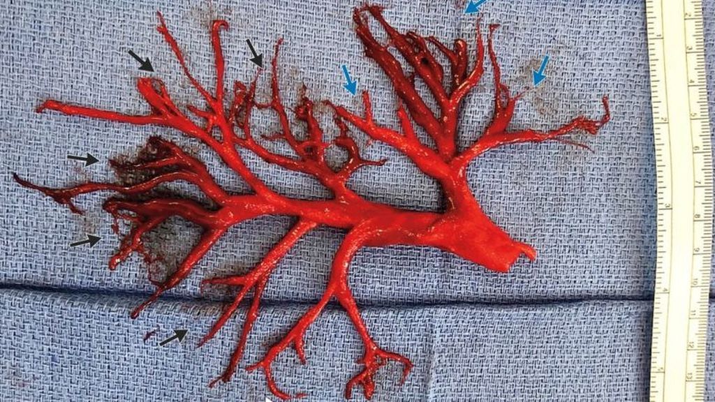 Un paciente con insuficiencia cardíaca tose un coagulo de sangre con forma de pasaje pulmonar Un paciente con insuficiencia cardíaca tose un coagulo de sangre con forma de pasaje pulmonar
