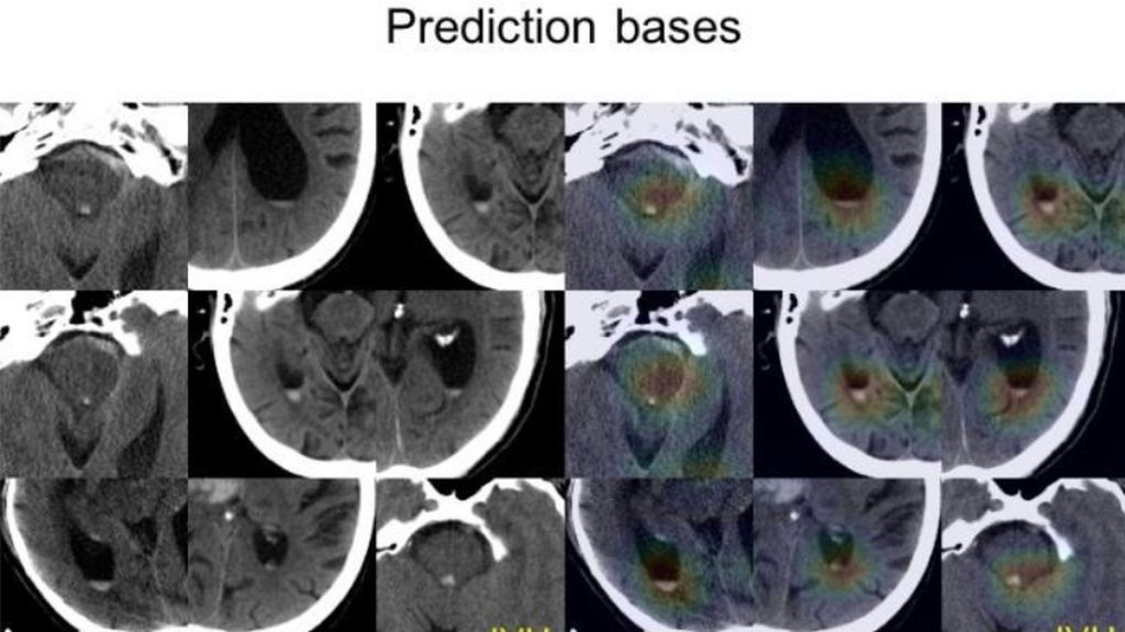 Crean un sistema de inteligencia artificial que diagnostica las hemorragias cerebrales