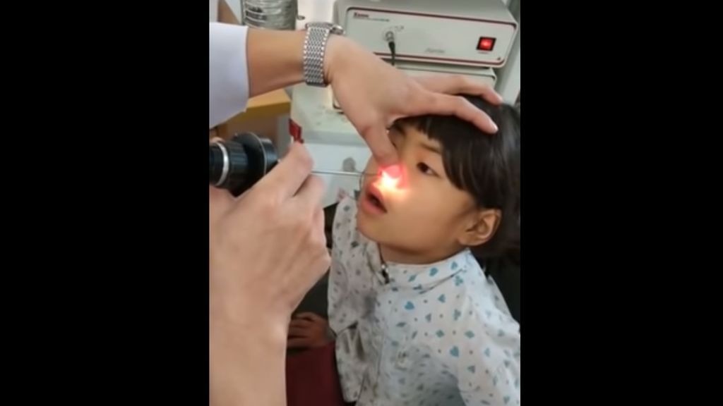 Una niña acude al médico por dolores de cabeza y le retiran de la nariz una extraña criatura