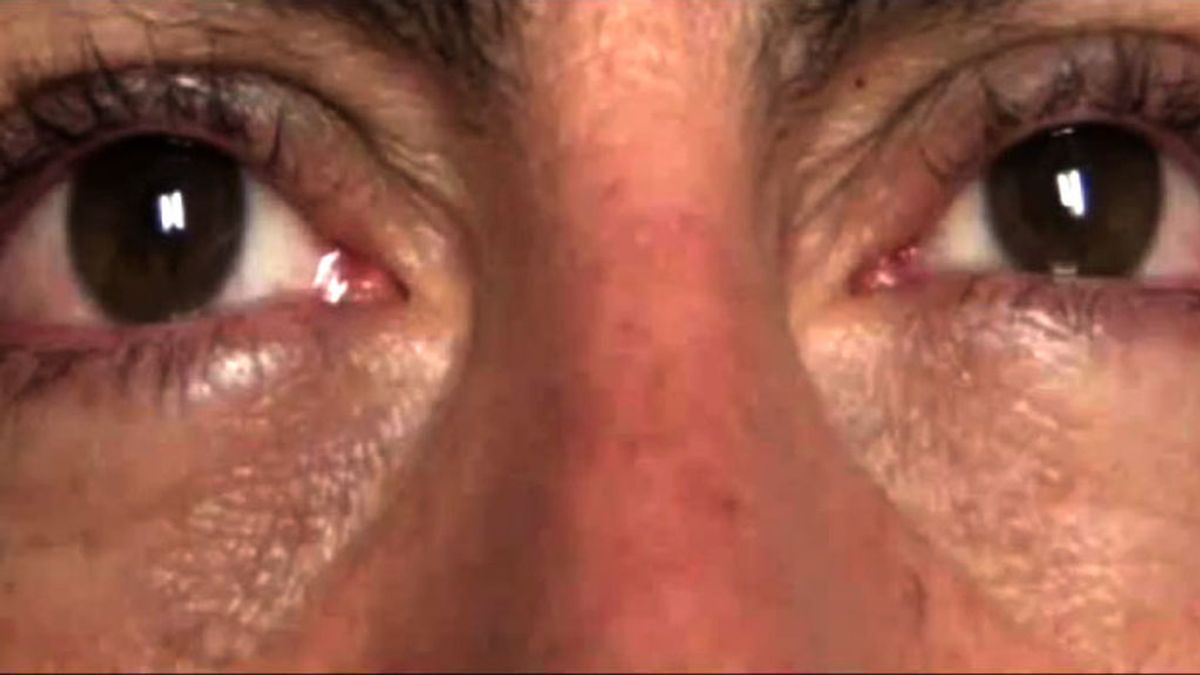 Una mujer sufre una lesión ocular al usar un medicamento para la disfunción eréctil por un error del farmacéutico