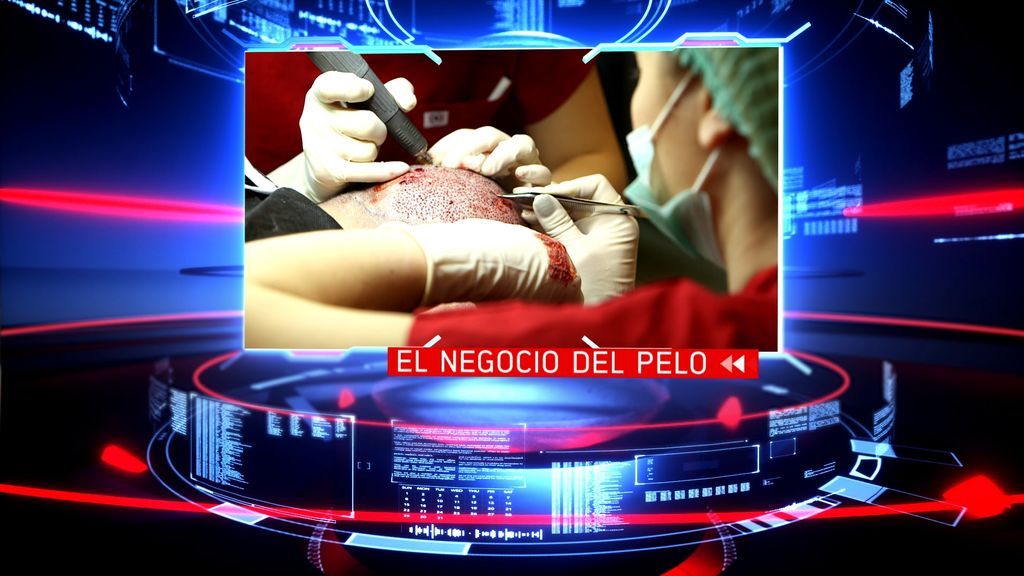 PTO MIRA-injertos pelo1