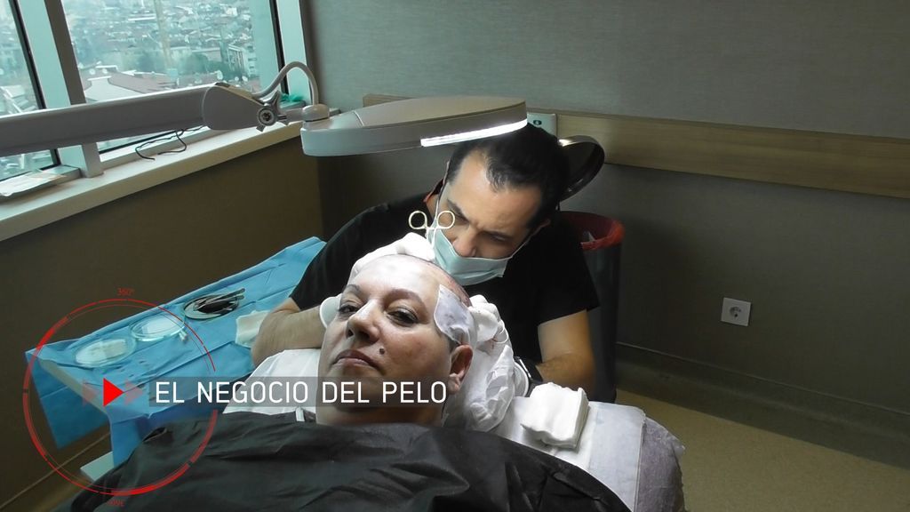 PTO MIRA-injertos pelo2
