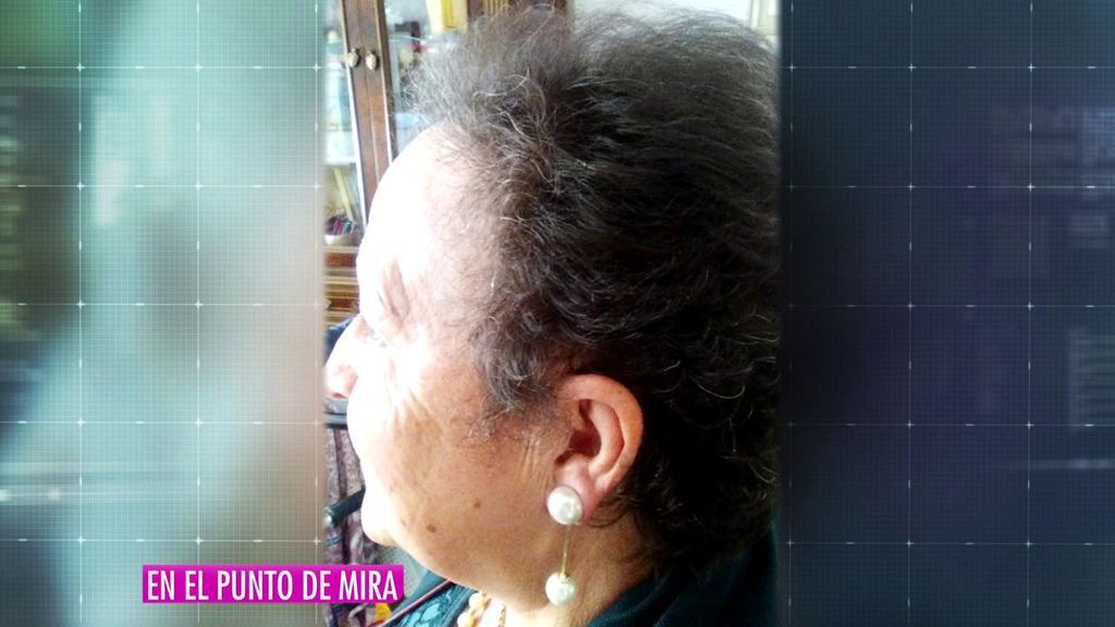 'En el punto de mira' analiza el negocio del pelo: así funcionan los trasplantes capilares en Turquía