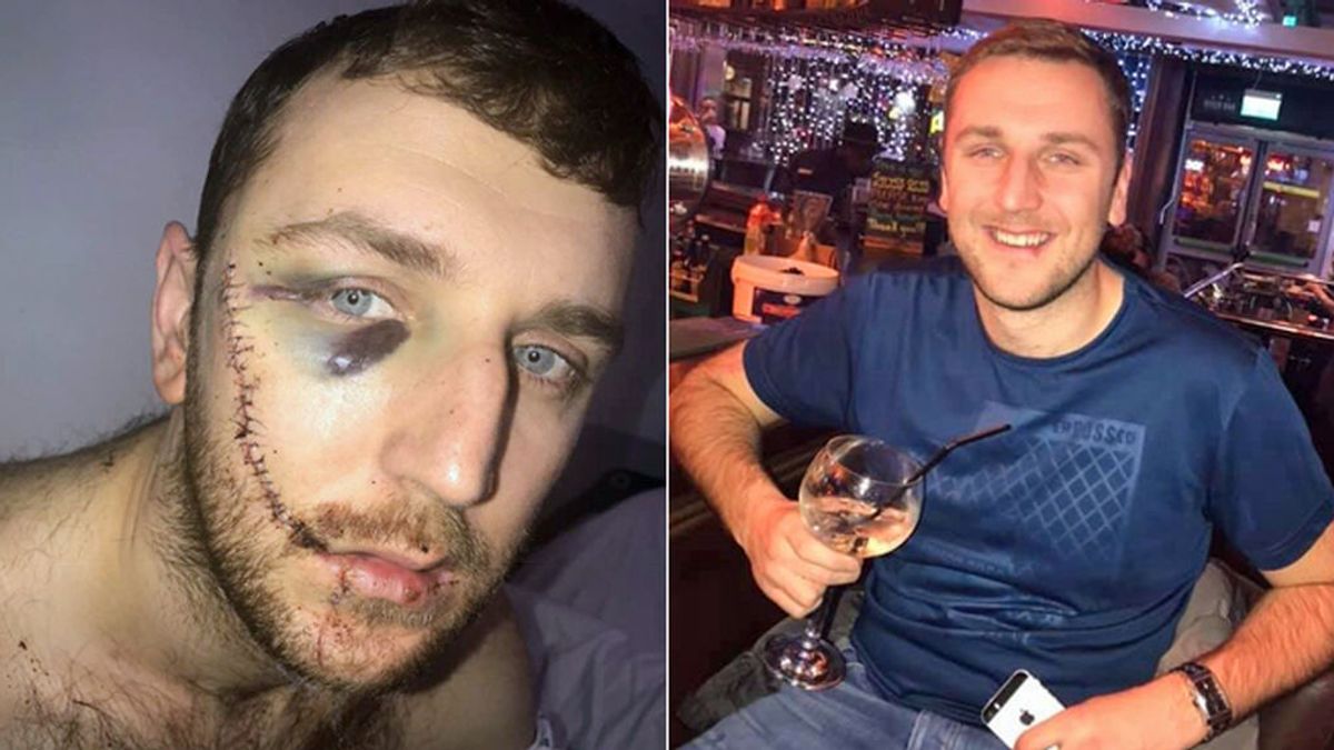 Un joven inglés muestra las heridas tras una pelea entre ultras del Everton y del Millwall: “No me puedo ni mirar al espejo”