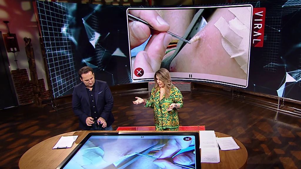 El vídeo viral que Iker no puede ni ver: extraen una larva del brazo de una chica