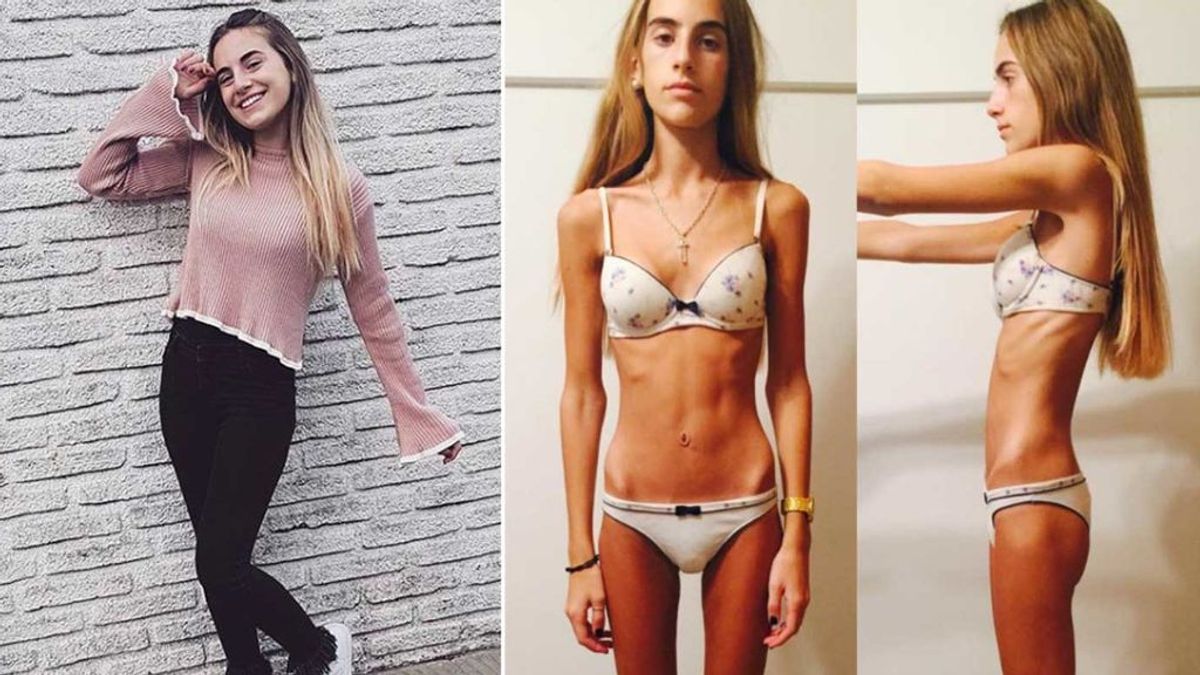 “Prefiero estar así y no como 4 años atrás”: El testimonio de una enferma de anorexia que llegó a pesar 35 kilos