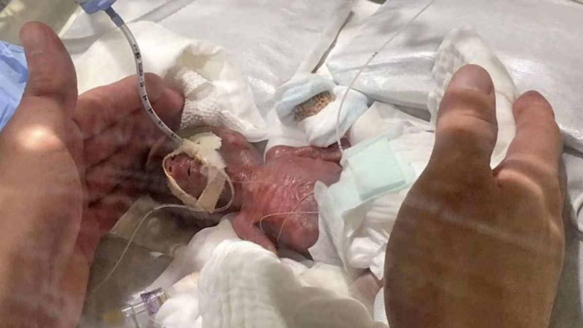 El bebé más pequeño del mundo, con 268 gramos de peso, sale del hospital en Japón