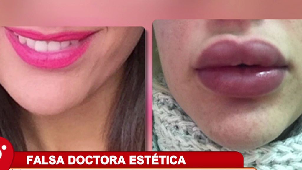 Una falsa doctora estética deja a una chica con los labios completamente deformados