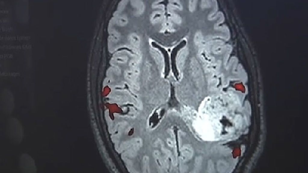 Operación pionera a un joven en Málaga para extirparle un tumor cerebral que le provocaba epilepsia