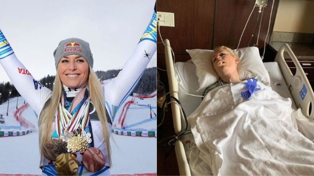 Imágenes extremadamente sensibles: Lindsey Vonn, esquiadora olímpica, publica imágenes de su operación de rodilla Imágenes extremadamente sensibles: Lindsey Vonn, esquiadora olímpica, publica imágenes de su operación de rodilla
