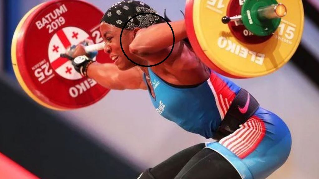 Una atleta sufre una terrible fractura de brazo cuando intentaba levantar 107 kilos Una atleta sufre una terrible fractura de brazo cuando intentaba levantar 107 kilos