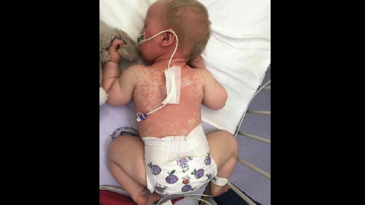 Una madre británica publica las imágenes de su bebé enferma de sarampión para concienciar a los 'antivacunas'