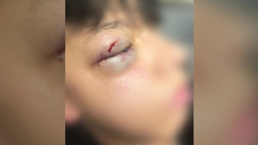 Brutal paliza a un niño de 15 años que tuvo que ser operado de un ojo