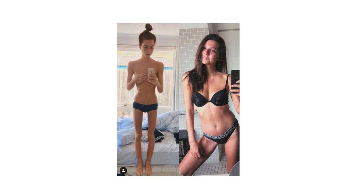 Con 35 kilos, dejó de reconocer a la gente y de hablar por culpa de la anorexia