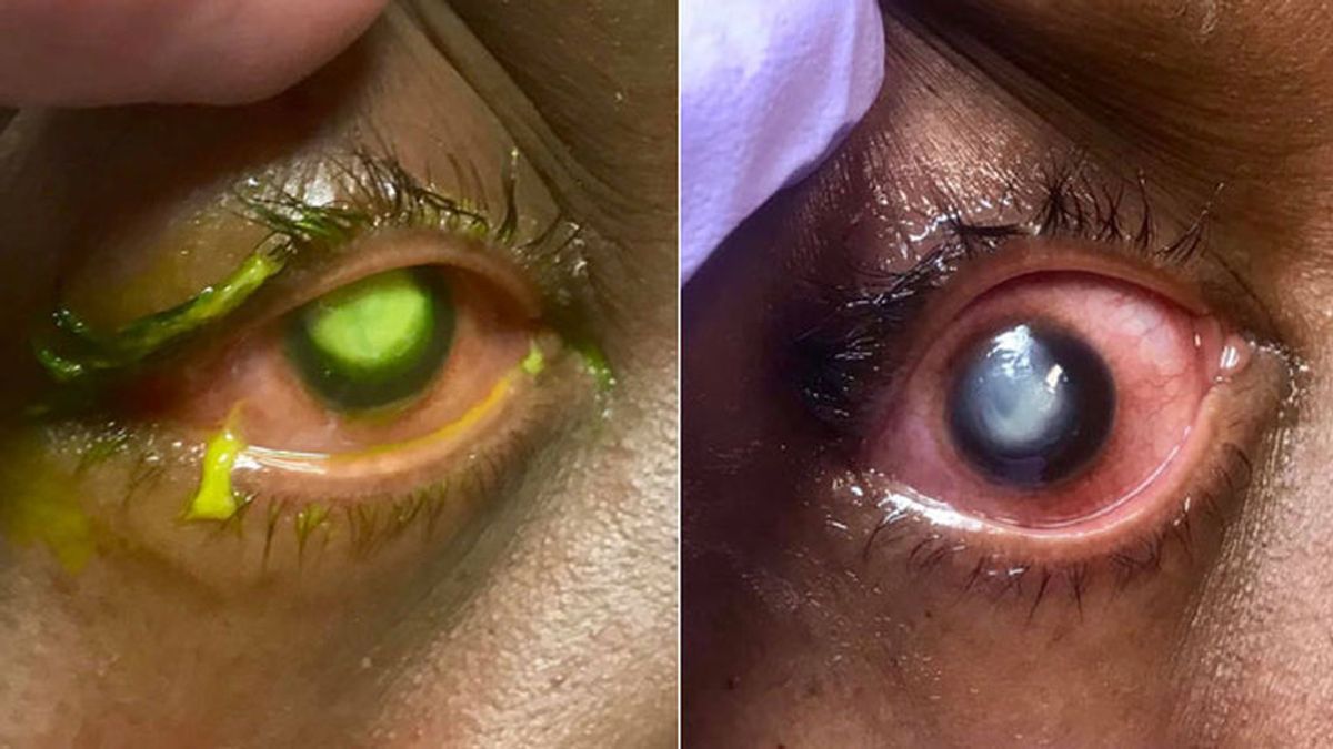 Un doctor muestra los peligros de dormir con las lentillas puestas