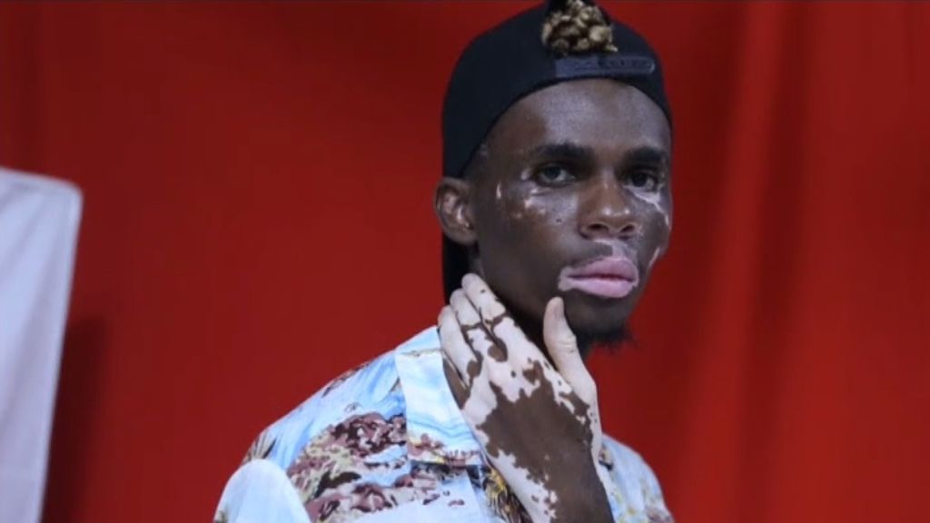 Un joven tanzano con una enfermedad de piel rara alcanza su sueño de ser modelo