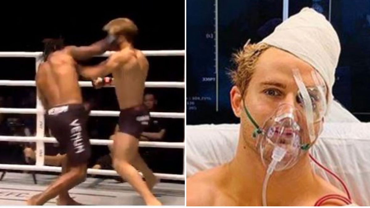 Las ocho fracturas en el rostro de un luchador tras un brutal puñetazo en un combate Las ocho fracturas en el rostro de un luchador tras un brutal puñetazo en un combate