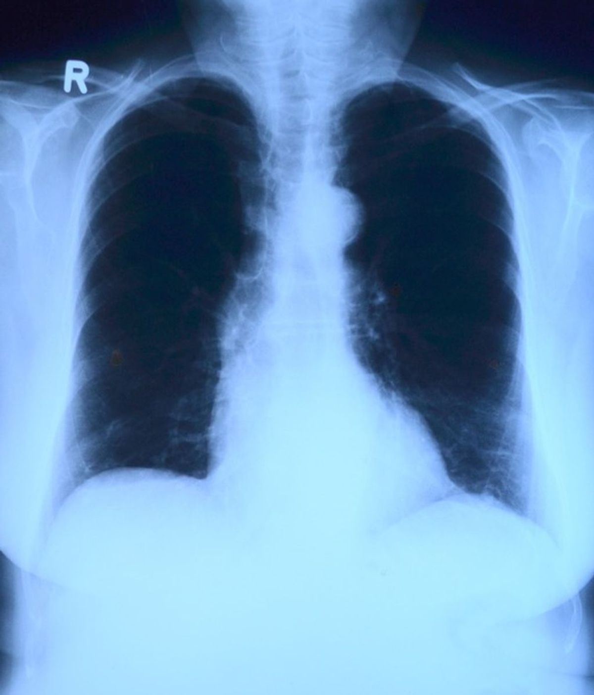 Un programa de Google es capaz de identificar más casos de cáncer de pulmón que las propias pruebas