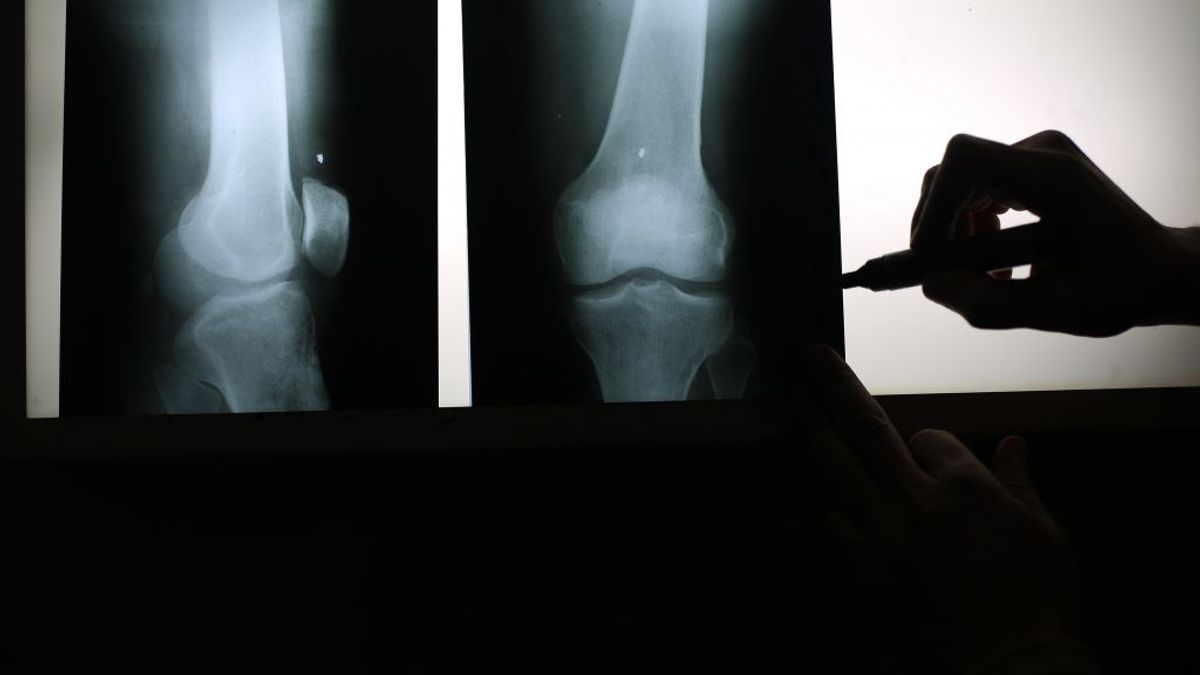Alertan de la aparición de fracturas vertebrales tras suspender un tratamiento contra la osteoporosis