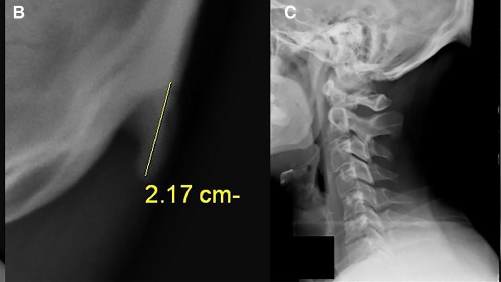 Detectan un 'cuerno' en el cráneo