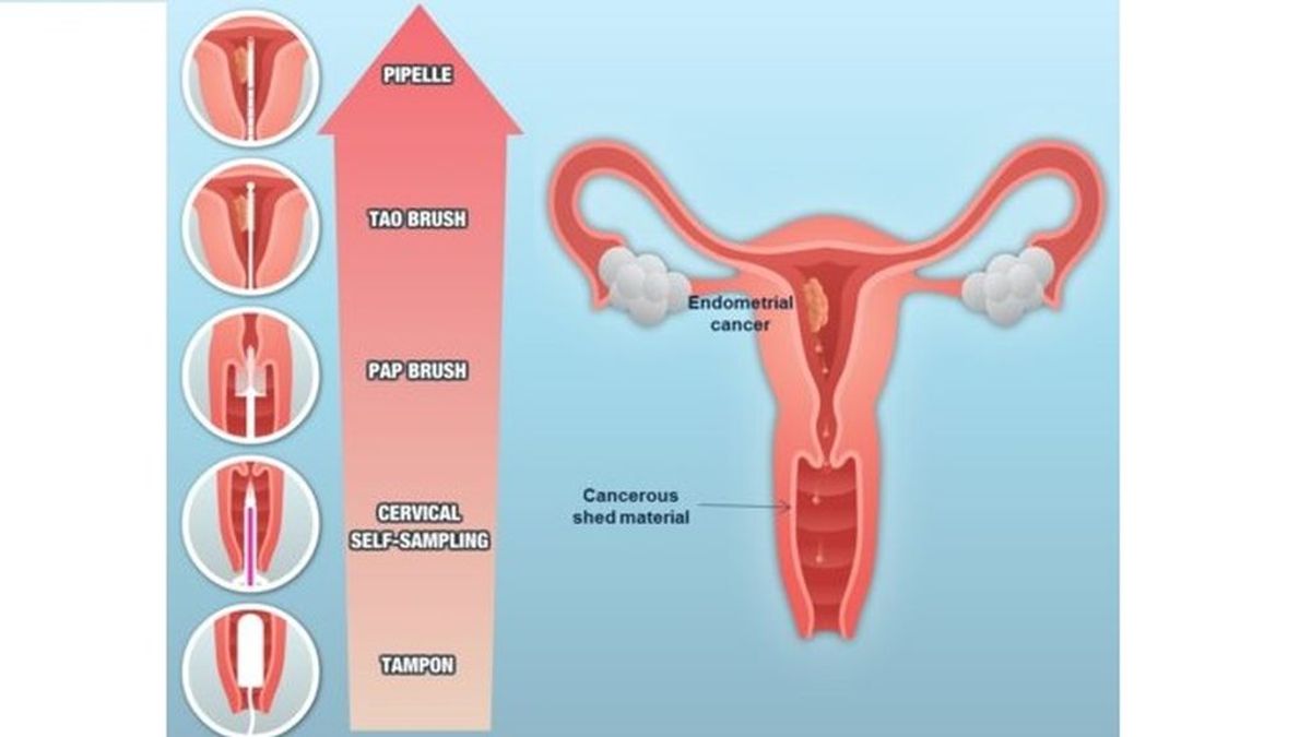 Prevención del cáncer de endometrio: Un estudio propone un análisis molecular para una mejor detección