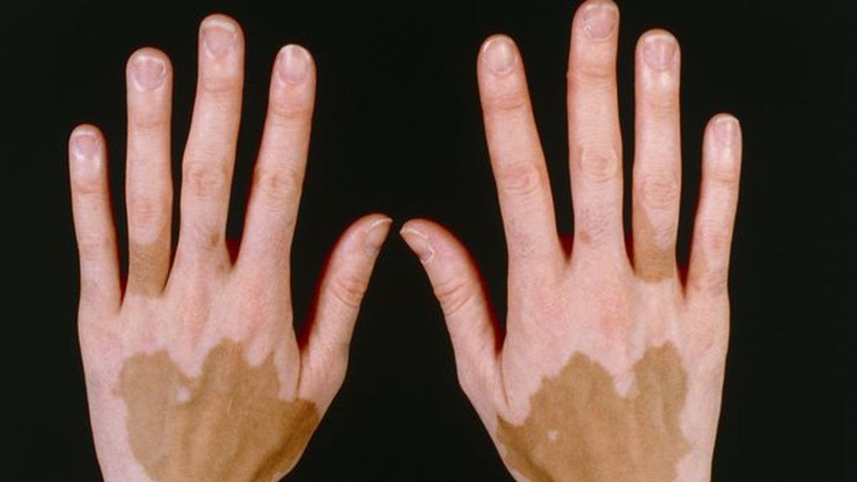 Nuevos estudios avanzan en las causas del vitíligo, la aparición de manchas sin coloración en la piel
