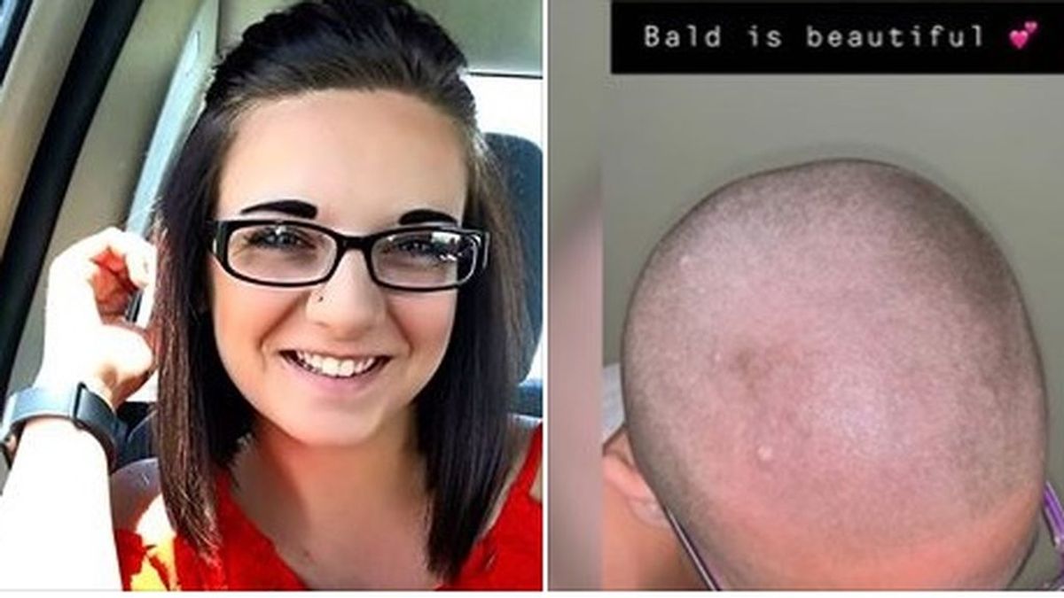 La terrible denuncia de una joven: se le cayó el pelo tras usar un champú acondicionador