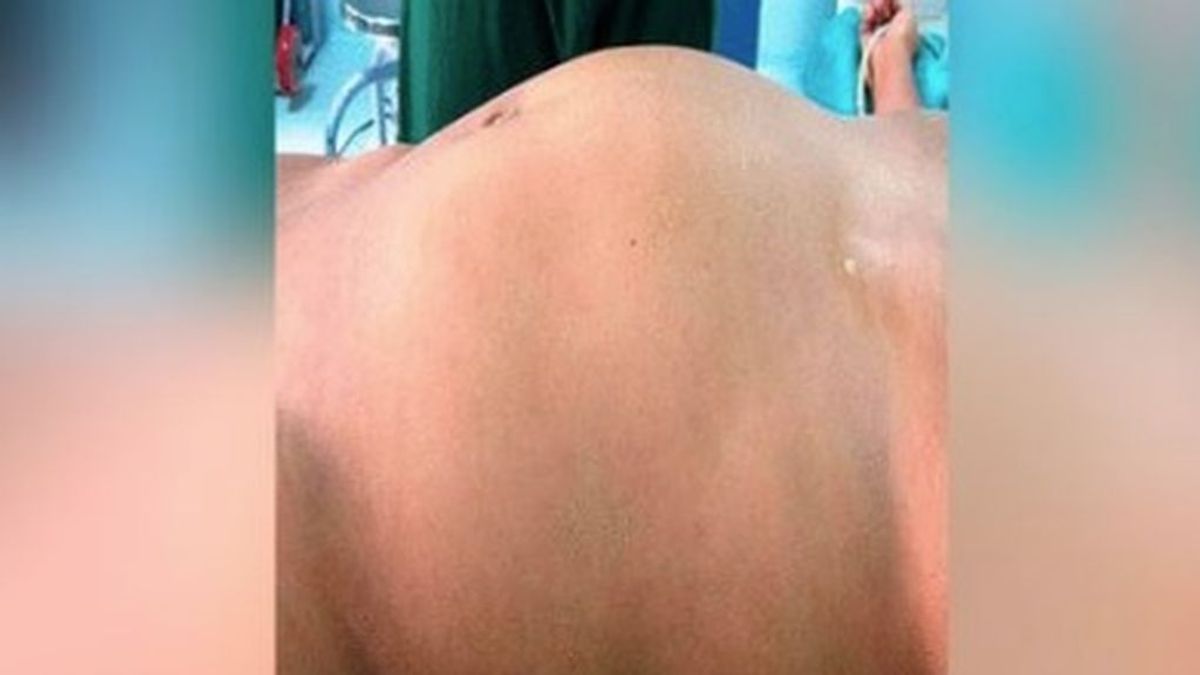 Una joven vive 17 años con un bulto en el abdomen: creían era un tumor, pero era el feto malformado de su gemelo