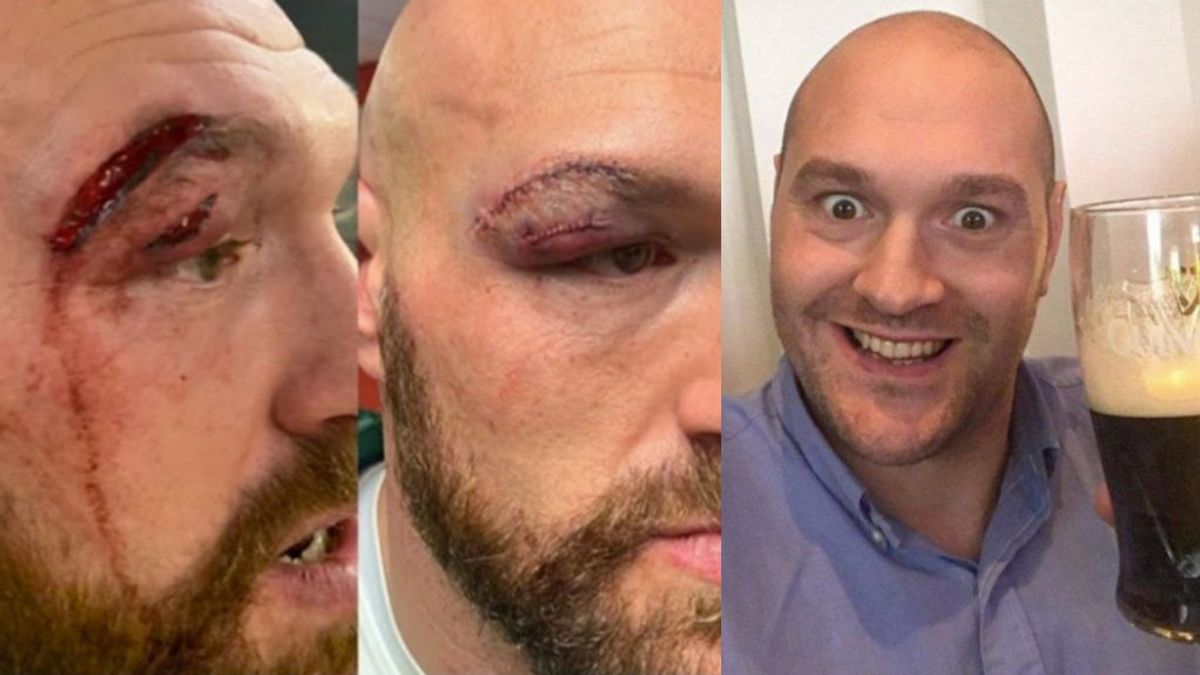 Tyson Fury recibe 47 puntos de sutura, se va al casino, gana 5.000 dólares y los gasta en cerveza Tyson Fury recibe 47 puntos de sutura, se va al casino, gana 5.000 dólares y los gasta en cerveza