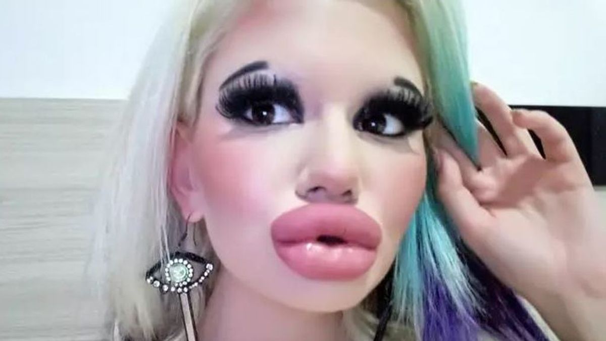 Una mujer triplica el tamaño de sus labios tras operarse quince veces