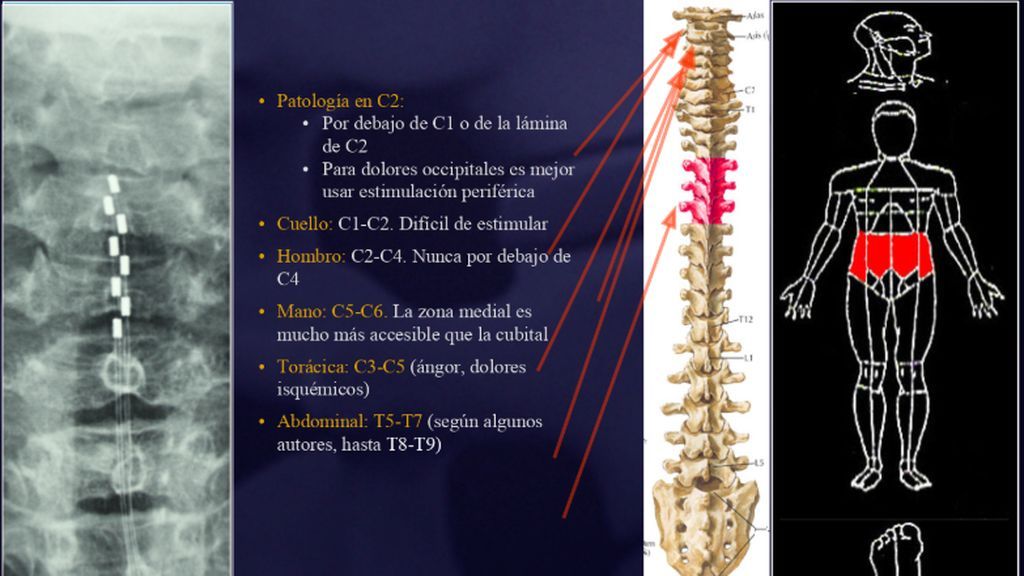 estimulacion