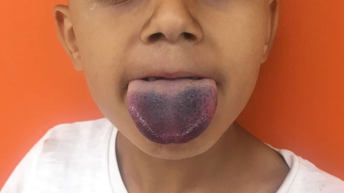 La lengua de un niño se queda atrapada en una botella de zumo al apurar las últimas gotas