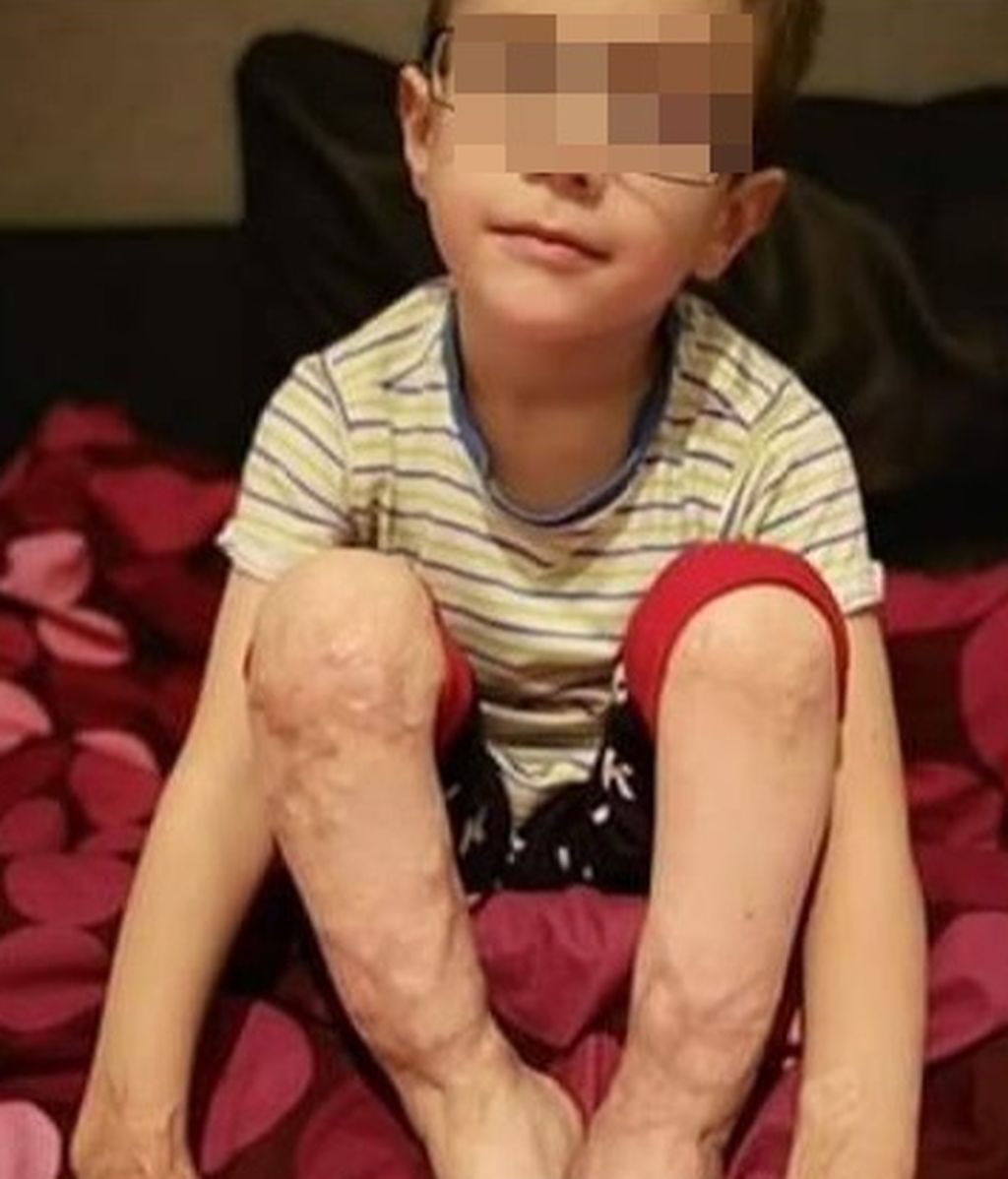 Jakub, el niño que quiere correr: tuvieron que amputarle los dedos de los pies y necesita una costosa intervención