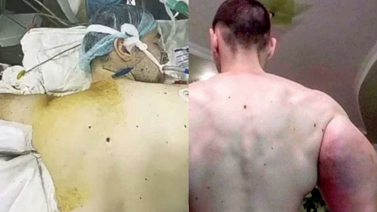 El 'Popeye Ruso' se opera los brazos para salvar su vida: se quita los litros de aceite que se inyectó en los bíceps