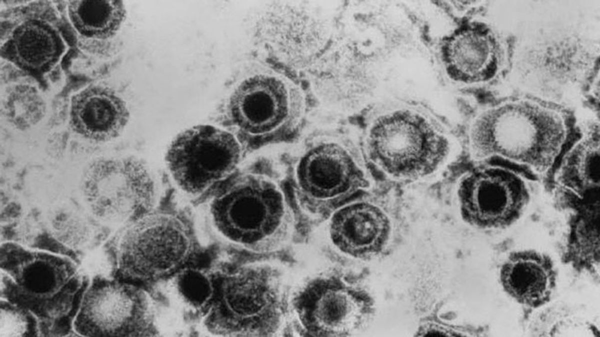 Un herpesvirus podría ser la causa de la esclerosis múltiple