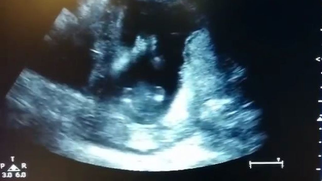 Eslovaquia obligará a las mujeres a ver una imagen del feto antes de abortar