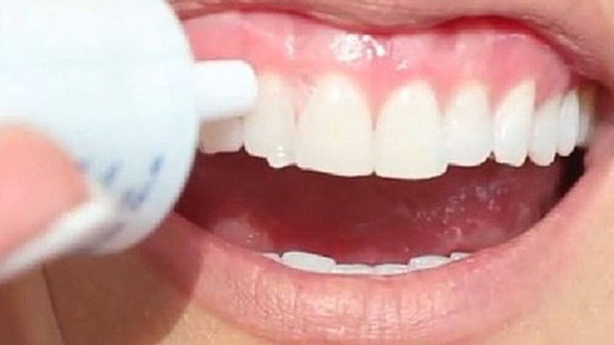 Peligro dental por seguir a los influencers: advierten del daño de los kits de blanqueamiento