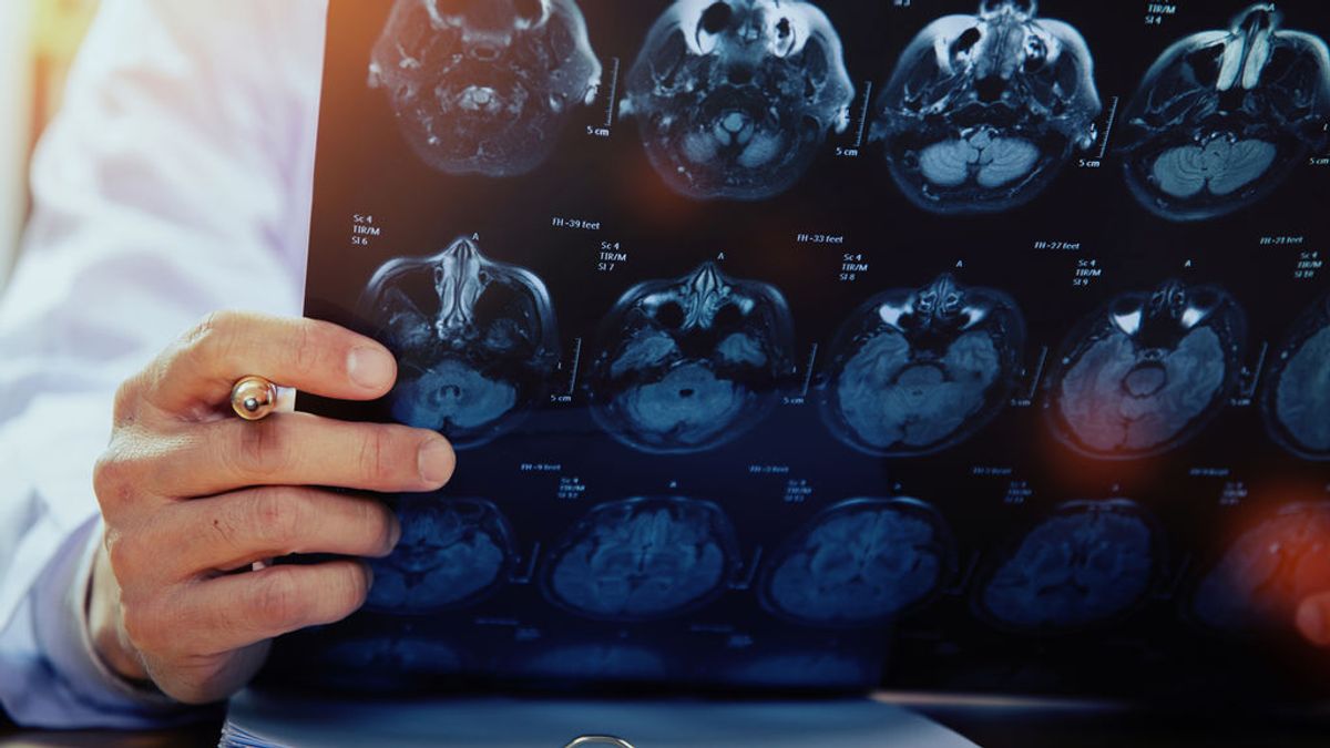 Ictus cerebral: cómo identificarlo a tiempo para salvar la vida